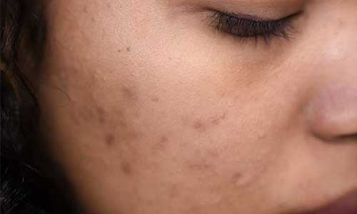Acne treatment
