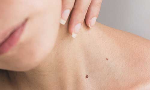 Skin cancer treatment